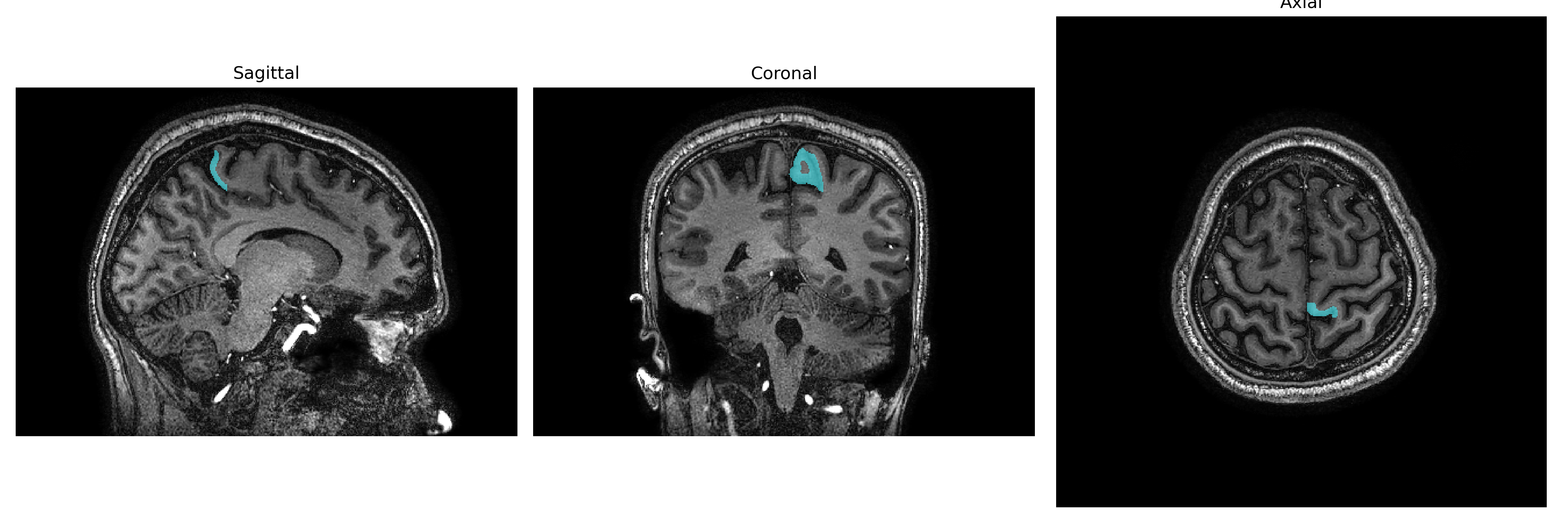 Triplanar T1